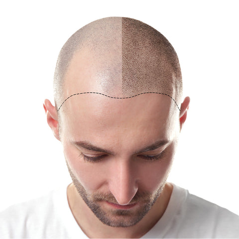 Scalp Micropigmentation Training Course